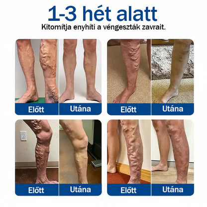 🧑‍⚕️Medistart® Visszérápoló Mikrotűs Gondozó Tapasz ⚡ Azonnali Megkönnyebbülés, Hosszú Távú Eredmények