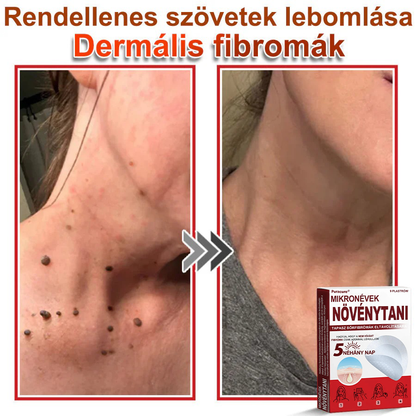 🧑‍⚕️PuraCure® Mikro-tűs botanikai bőrnövedék-eltávolító ✅✅Készült Magyarországon