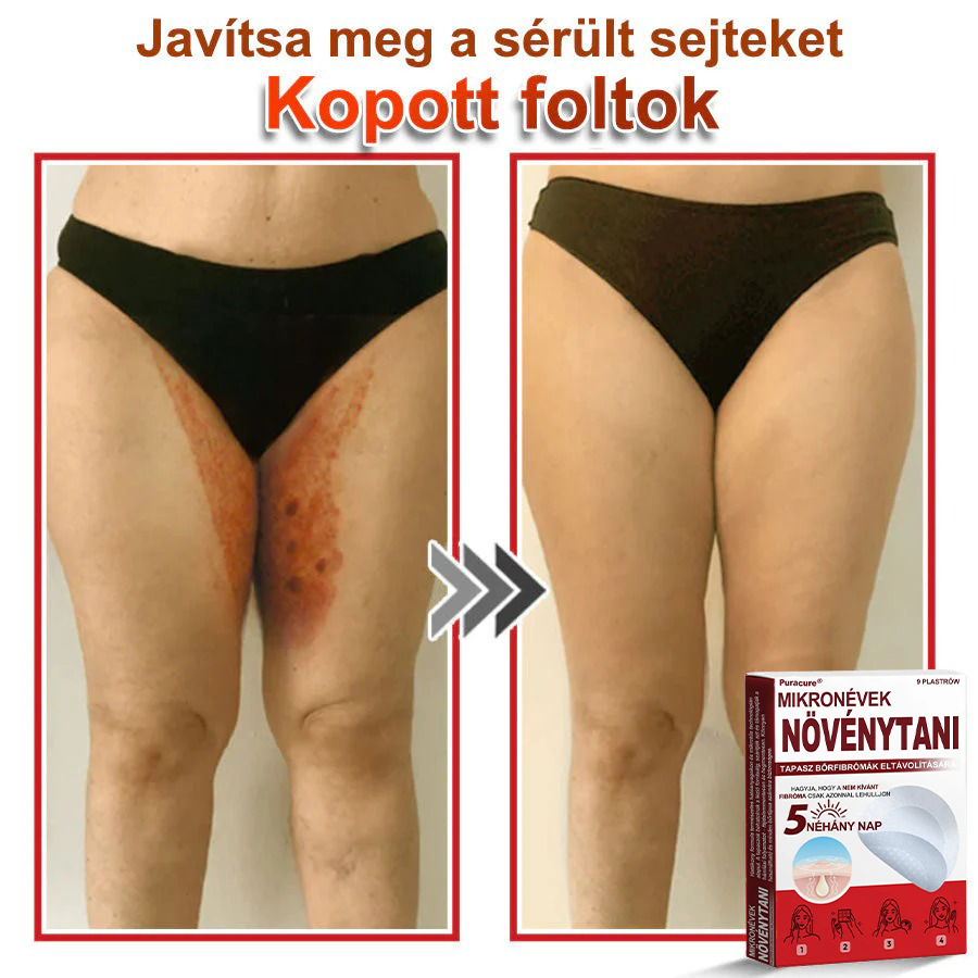 🧑‍⚕️PuraCure® Mikro-tűs botanikai bőrnövedék-eltávolító ✅✅Készült Magyarországon