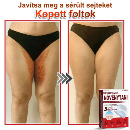 🧑‍⚕️PuraCure® Mikro-tűs botanikai bőrnövedék-eltávolító ✅✅Készült Magyarországon