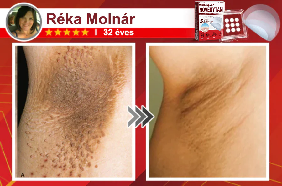 🧑‍⚕️PuraCure® Mikro-tűs botanikai bőrnövedék-eltávolító ✅✅Készült Magyarországon