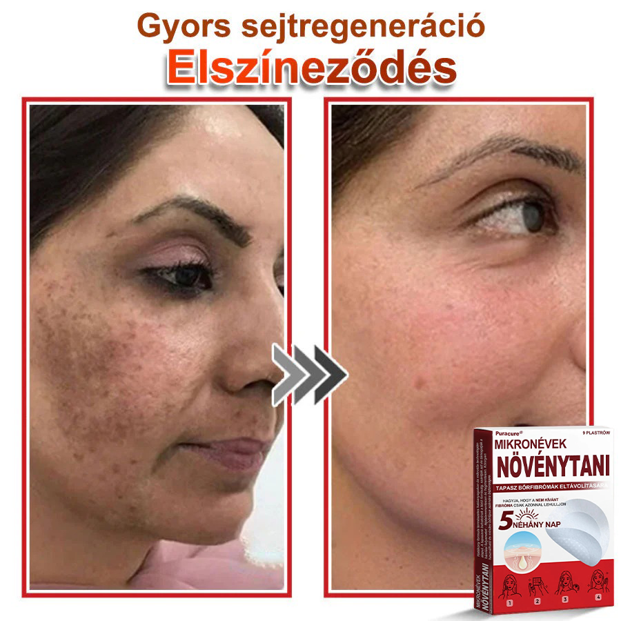 🧑‍⚕️PuraCure® Mikro-tűs botanikai bőrnövedék-eltávolító ✅✅Készült Magyarországon