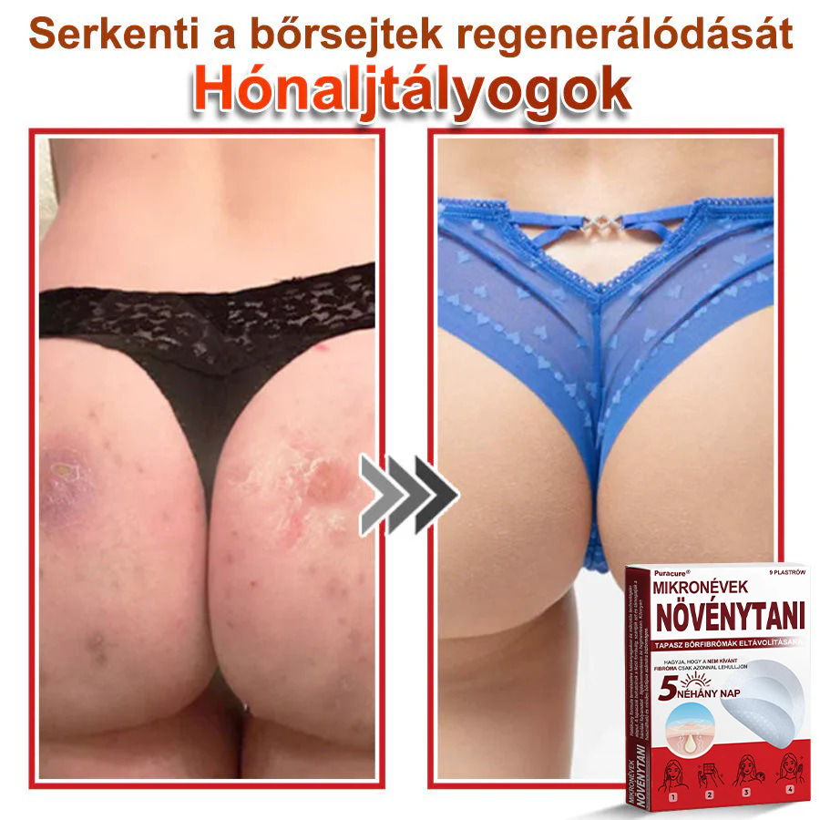 🧑‍⚕️PuraCure® Mikro-tűs botanikai bőrnövedék-eltávolító ✅✅Készült Magyarországon