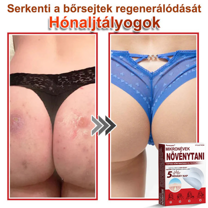 🧑‍⚕️PuraCure® Mikro-tűs botanikai bőrnövedék-eltávolító ✅✅Készült Magyarországon