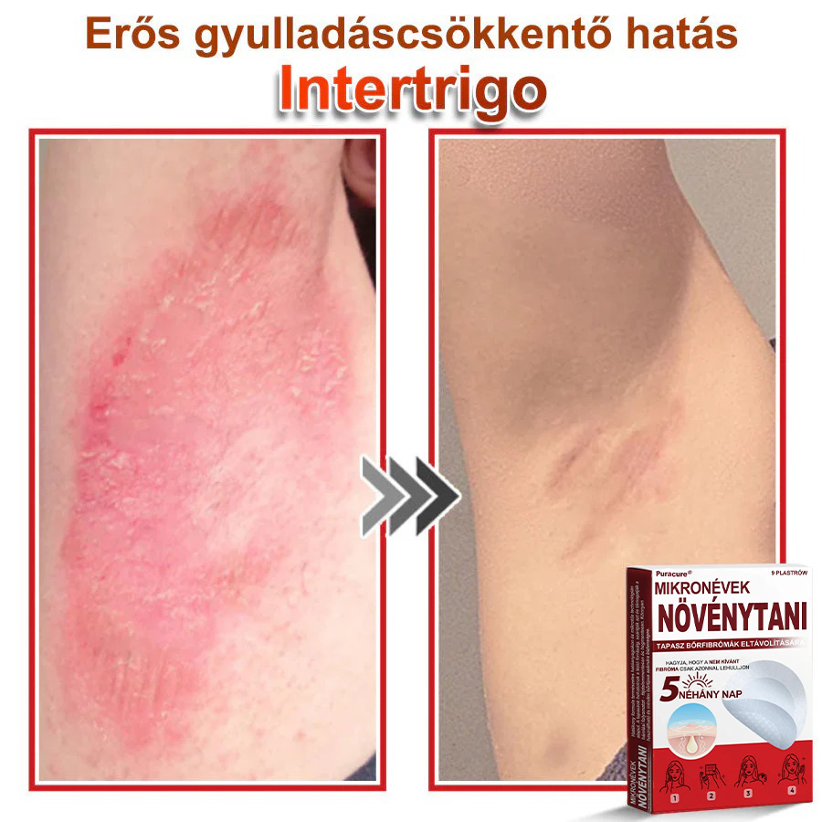 🧑‍⚕️PuraCure® Mikro-tűs botanikai bőrnövedék-eltávolító ✅✅Készült Magyarországon
