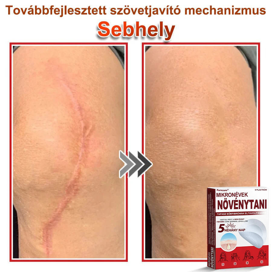 🧑‍⚕️PuraCure® Mikro-tűs botanikai bőrnövedék-eltávolító ✅✅Készült Magyarországon