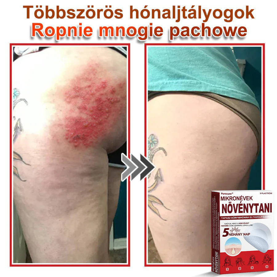 🧑‍⚕️PuraCure® Mikro-tűs botanikai bőrnövedék-eltávolító ✅✅Készült Magyarországon