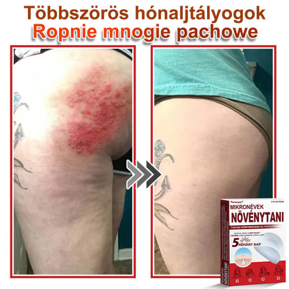 🧑‍⚕️PuraCure® Mikro-tűs botanikai bőrnövedék-eltávolító ✅✅Készült Magyarországon