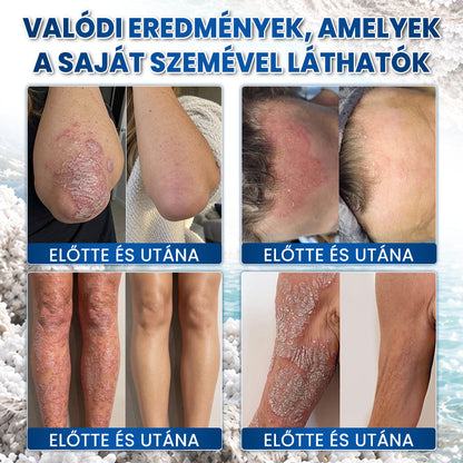 ✨Medistart® PSZORIÁZIS SPECIÁLIS BŐRÁPOLÓ