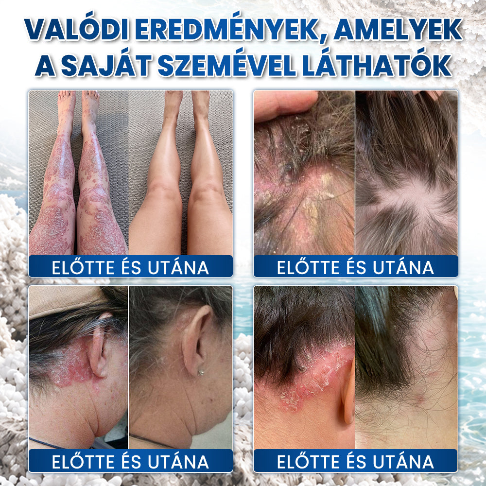 ✨Medistart® PSZORIÁZIS SPECIÁLIS BŐRÁPOLÓ