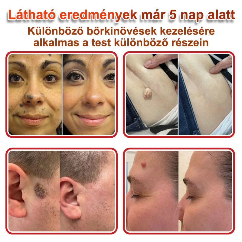 🧑‍⚕️PuraCure® Mikro-tűs botanikai bőrnövedék-eltávolító ✅✅Készült Magyarországon