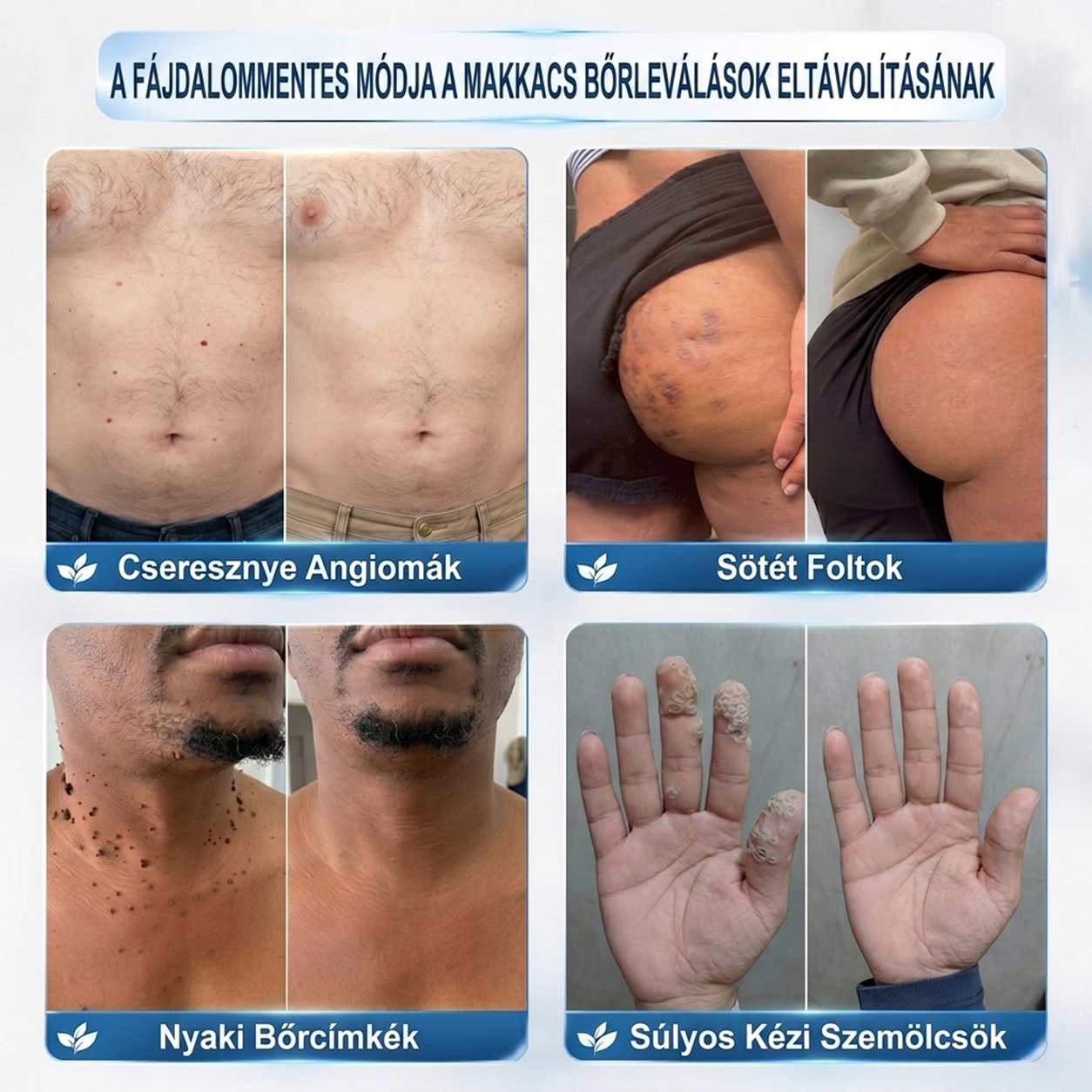 🧑‍⚕️𝐏𝐮𝐫𝐚𝐂𝐮𝐫𝐞® 𝐌𝐢𝐤𝐫𝐨-𝐭ű𝐬 𝐛𝐨𝐭𝐚𝐧𝐢𝐤𝐚𝐢 𝐛ő𝐫𝐧ö𝐯𝐞𝐝é𝐤-𝐞𝐥𝐭á𝐯𝐨𝐥í𝐭ó ✅✅𝐊é𝐬𝐳ü𝐥𝐭 𝐌𝐚𝐠𝐲𝐚𝐫𝐨𝐫𝐬𝐳á𝐠𝐨𝐧