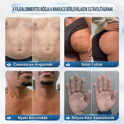🧑‍⚕️𝐏𝐮𝐫𝐚𝐂𝐮𝐫𝐞® 𝐌𝐢𝐤𝐫𝐨-𝐭ű𝐬 𝐛𝐨𝐭𝐚𝐧𝐢𝐤𝐚𝐢 𝐛ő𝐫𝐧ö𝐯𝐞𝐝é𝐤-𝐞𝐥𝐭á𝐯𝐨𝐥í𝐭ó ✅✅𝐊é𝐬𝐳ü𝐥𝐭 𝐌𝐚𝐠𝐲𝐚𝐫𝐨𝐫𝐬𝐳á𝐠𝐨𝐧