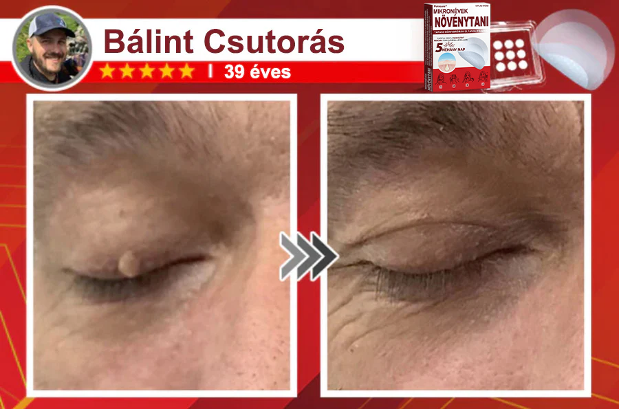 🧑‍⚕️PuraCure® Mikro-tűs botanikai bőrnövedék-eltávolító ✅✅Készült Magyarországon