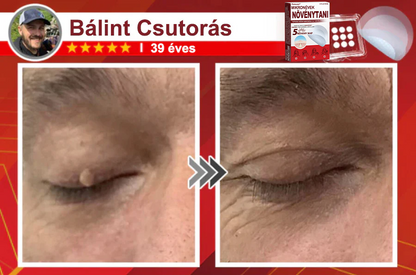 🧑‍⚕️PuraCure® Mikro-tűs botanikai bőrnövedék-eltávolító ✅✅Készült Magyarországon