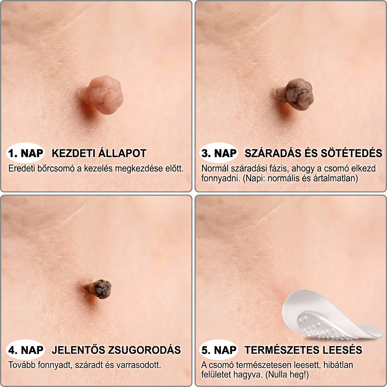 🧑‍⚕️𝐏𝐮𝐫𝐚𝐂𝐮𝐫𝐞® 𝐌𝐢𝐤𝐫𝐨-𝐭ű𝐬 𝐛𝐨𝐭𝐚𝐧𝐢𝐤𝐚𝐢 𝐛ő𝐫𝐧ö𝐯𝐞𝐝é𝐤-𝐞𝐥𝐭á𝐯𝐨𝐥í𝐭ó ✅✅𝐊é𝐬𝐳ü𝐥𝐭 𝐌𝐚𝐠𝐲𝐚𝐫𝐨𝐫𝐬𝐳á𝐠𝐨𝐧