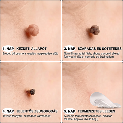 🧑‍⚕️𝐏𝐮𝐫𝐚𝐂𝐮𝐫𝐞® 𝐌𝐢𝐤𝐫𝐨-𝐭ű𝐬 𝐛𝐨𝐭𝐚𝐧𝐢𝐤𝐚𝐢 𝐛ő𝐫𝐧ö𝐯𝐞𝐝é𝐤-𝐞𝐥𝐭á𝐯𝐨𝐥í𝐭ó ✅✅𝐊é𝐬𝐳ü𝐥𝐭 𝐌𝐚𝐠𝐲𝐚𝐫𝐨𝐫𝐬𝐳á𝐠𝐨𝐧