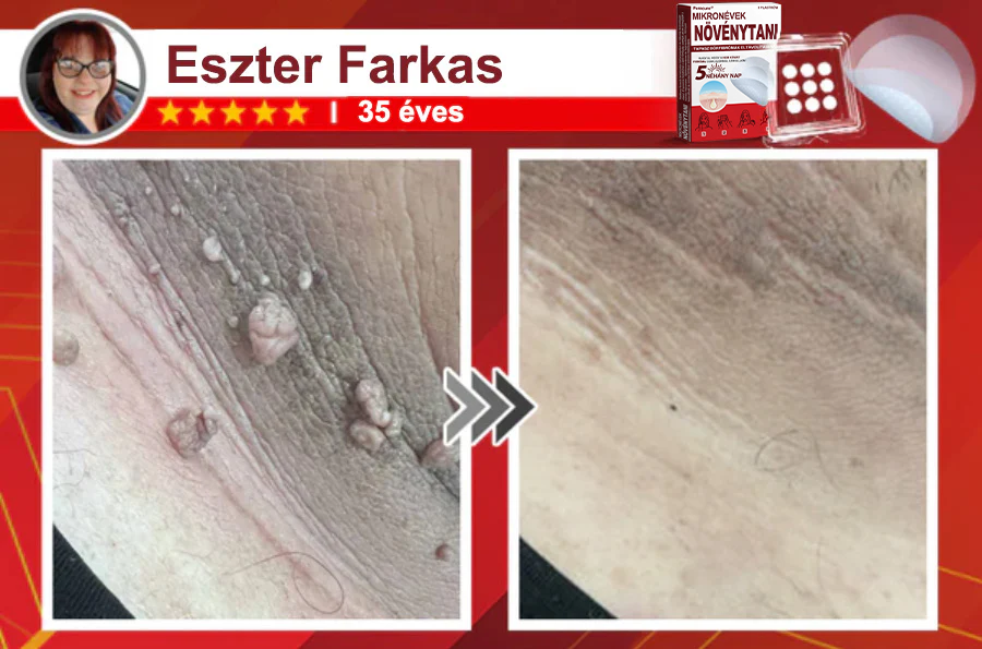 🧑‍⚕️PuraCure® Mikro-tűs botanikai bőrnövedék-eltávolító ✅✅Készült Magyarországon