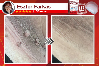 🧑‍⚕️PuraCure® Mikro-tűs botanikai bőrnövedék-eltávolító ✅✅Készült Magyarországon