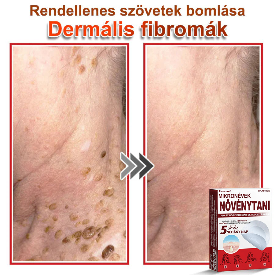🧑‍⚕️PuraCure® Mikro-tűs botanikai bőrnövedék-eltávolító ✅✅Készült Magyarországon