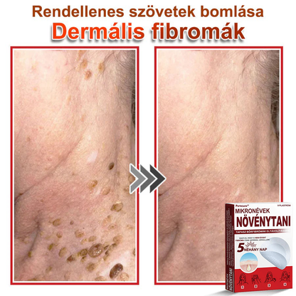 🧑‍⚕️PuraCure® Mikro-tűs botanikai bőrnövedék-eltávolító ✅✅Készült Magyarországon