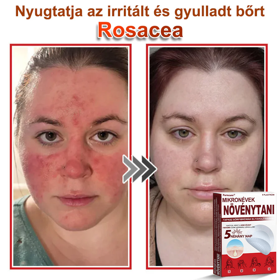 🧑‍⚕️PuraCure® Mikro-tűs botanikai bőrnövedék-eltávolító ✅✅Készült Magyarországon