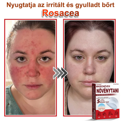 🧑‍⚕️PuraCure® Mikro-tűs botanikai bőrnövedék-eltávolító ✅✅Készült Magyarországon