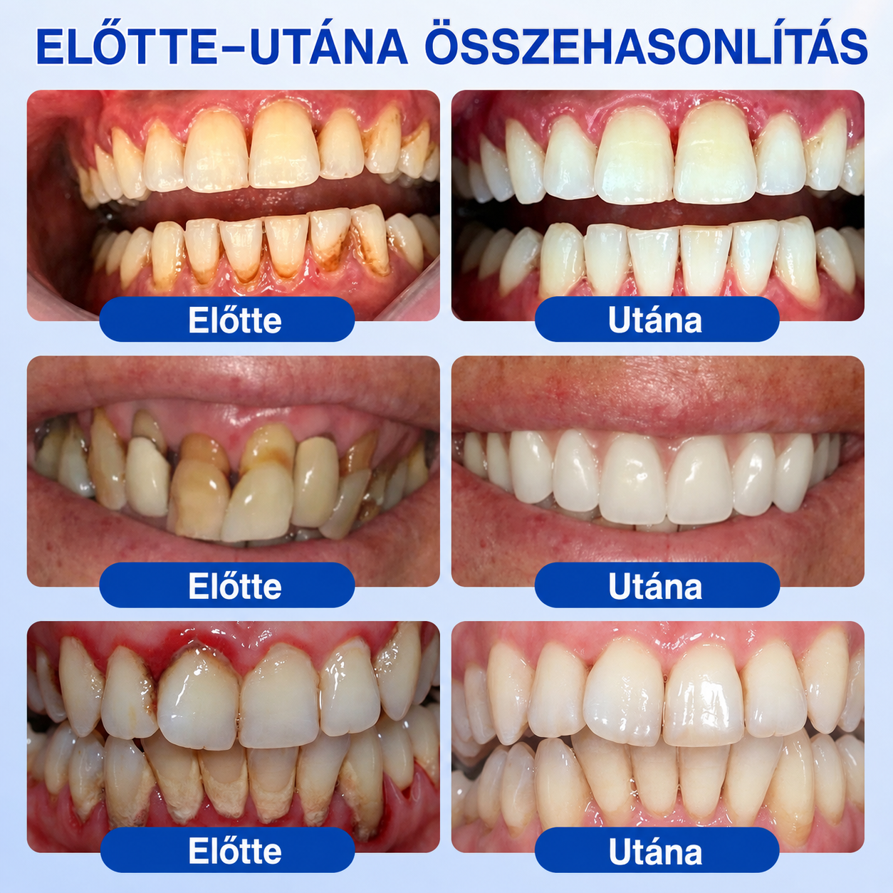 🇭🇺👨‍⚕️✅🦷 PuraCure® ÍNYMEGÚJÍTÓ – Parodontális helyreállító gél🧂