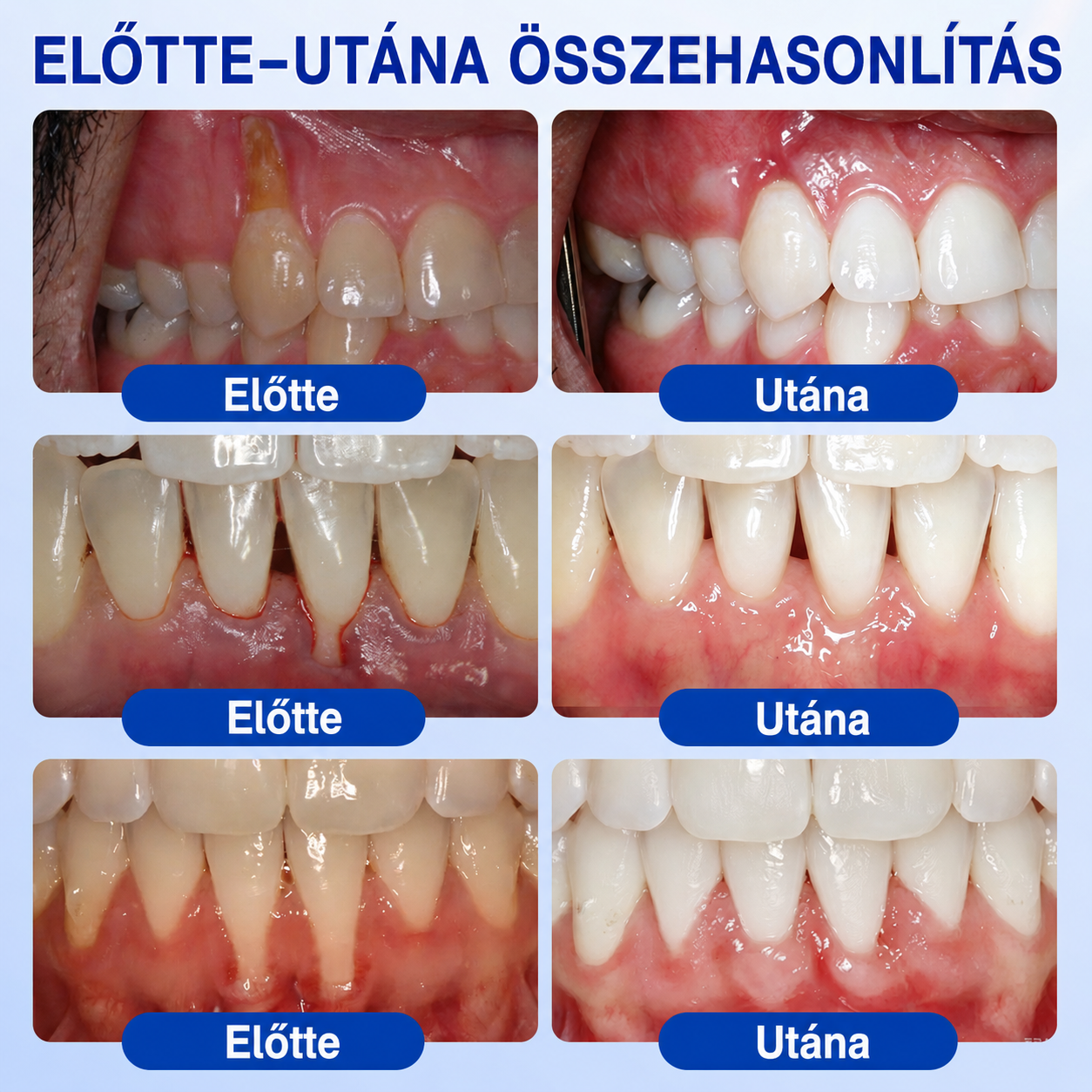 🇭🇺👨‍⚕️✅🦷 PuraCure® ÍNYMEGÚJÍTÓ – Parodontális helyreállító gél🧂